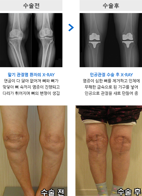 전치환술