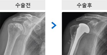 어깨 인공관절