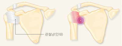 유착성관절낭염