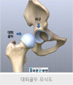 대퇴경부골절