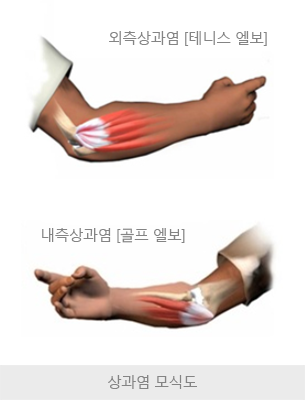 테니스 엘보 / 골프 엘보