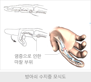 수근관 증후군 모식도