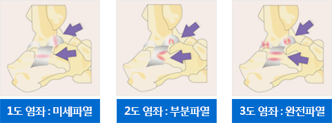 발목염좌 모식도